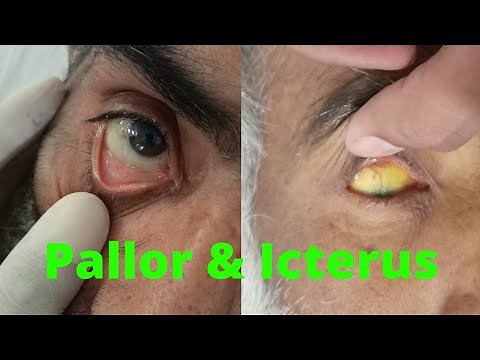 PALLOR and ICTERUS in EYE | ANEMIA and JAUNDICE in eye examination