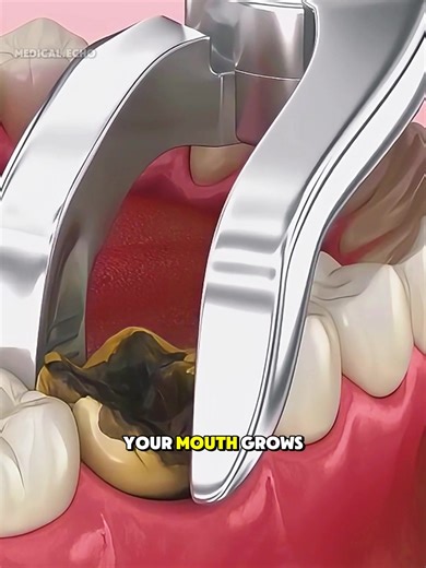 Wisdom Teeth Removal Procedure #wisdomteeth #wisdomteethremoval #wisdomteethrecovery #medicalanimation