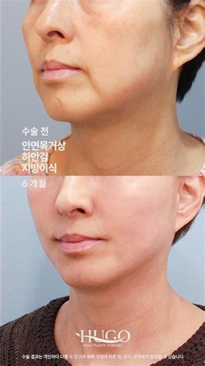 6-Month Before & After: Facelift + Lower Blepharoplasty + Fat Grafting