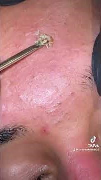 • Blackhead Cleaning You Need to See 😳 #skincare #skincareroutine #blackheadremoval #shorts