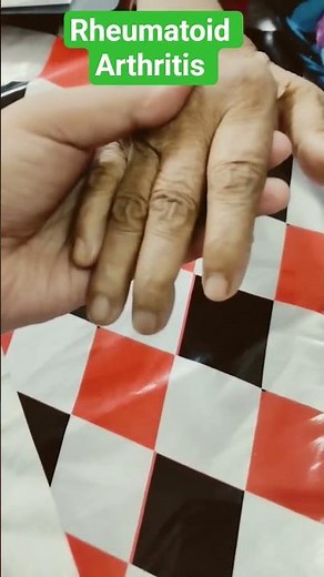 Hand of Rheumatoid Arthritis – Deformities Explained