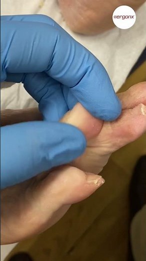 Painful corn removal from between toes