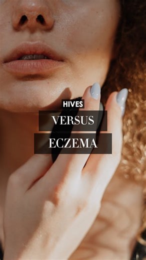 Madame Sweat | Here's how to spot the difference between #hives & #eczema in the early stages!😬 #personalhygiene #skinrash #allergens | Instagram