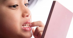 Dental Fluorosis: Too Much Fluoride, White Spots on Teeth