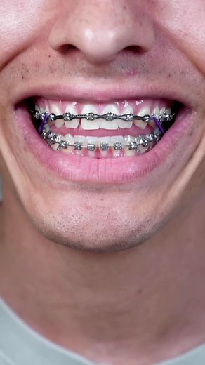 Proper Braces Cleaning Techniques for Healthier Teeth