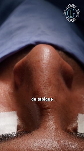 Corrección del Tabique Nasal: Septoplastía y Septorrinoplastía