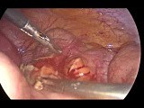 Laparoscopic appendectomy - pregnant woman • Video • MEDtube.net