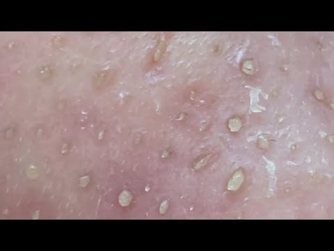 The Deepest Nose Sebum | Self Sebum Extraction #pimplepopping #acne #pimple #sebum