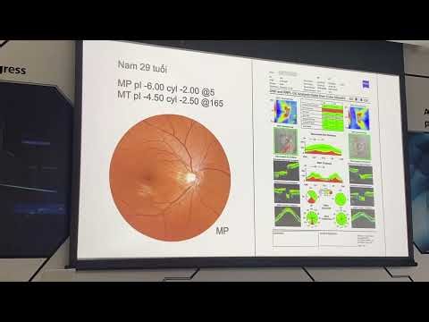 Phần 3.1: Oct trong glocom góc mở- BS LÊ PHÚ