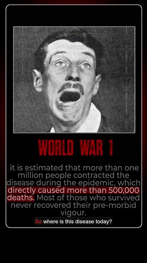 Most Bizarre Disease . . . #brain #disease #science #gauravthakur #getsetflyscience | Gaurav Thakur