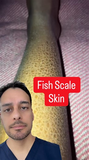 Dr. VC | Mind & Medicine on Instagram: "Ichthyosis vulgaris — explained👇 This is a genetic skin condition where the skin doesn’t shed dead cells normally. Instead, they build up → causing dry, thick, “fish-scale” skin, especially on the shins, arms, and trunk. A few key points most people don’t know: • It often starts in childhood • It’s not contagious • Cold, dry weather makes it worse • It commonly overlaps with eczema and allergies There’s no cure—but it’s manageable: ✔️ Daily moisturizing (