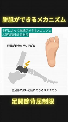 歩行によって胼胝ができるメカニズム⑦距腿関節の背屈制限 #理学療法 #ptタイガー #日本足病学協会 #足病学