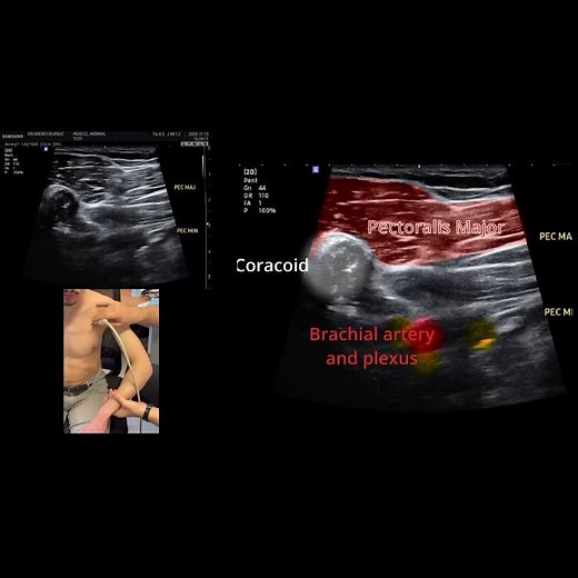 Pectoralis major and minor spasticity – Grand pectoral et petit pectoral spasticité Short