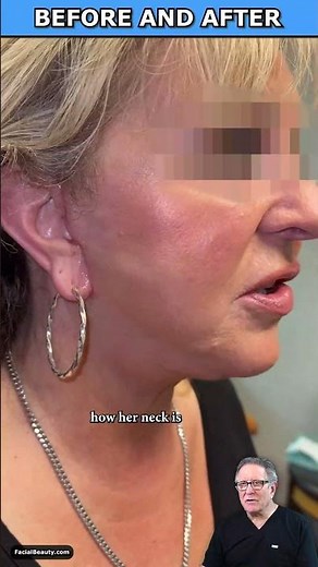 AMAZING Plastic Surgery Results! #plasticsurgery #beforeandafter #facelift