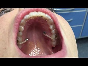 Invisalign protocols. invisalign, aligners and IZC screws to solve a severe Openbite malocclusion.