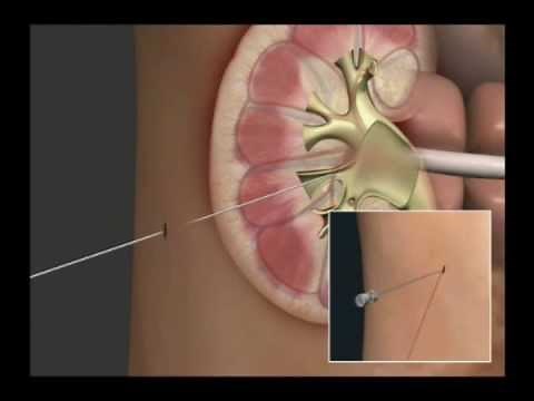 Navilyst Kidney Drainage Animation