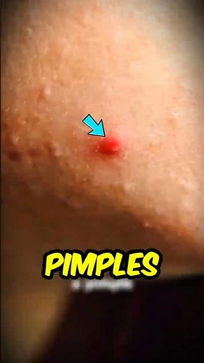 If You Ever Wondered Why Popping Pimples Makes Them Worse😲