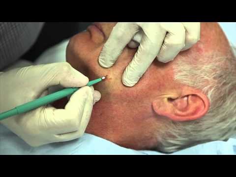 How to remove facial warts using Cautery