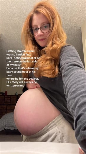 Understanding Stretch Marks During Pregnancy Journey