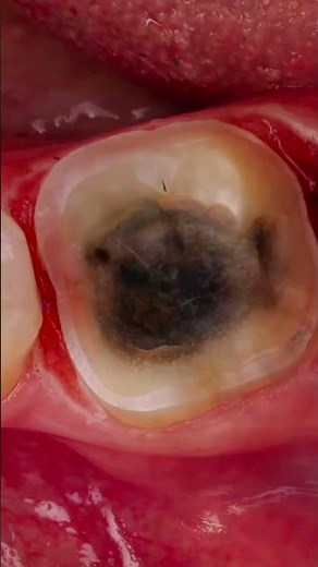 Precision Restorative Dentistry: Solea Laser + CAD/CAM Digital Workflow