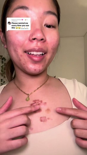 Peeling off Pimple Patch on My Chest - Acne Skincare Routine