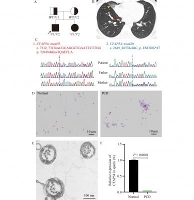 Lack of CFAP54 Causes Primary Ciliary Dyskinesia in a Mouse Model and Human Patients | Newswise
