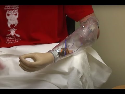 Michelangelo Prosthetic Hand - Arm Dynamics
