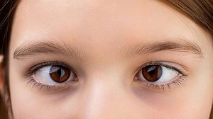 Dancing Eye Syndrome: Expert Explains Causes, Symptoms, And Treatment For This Condition