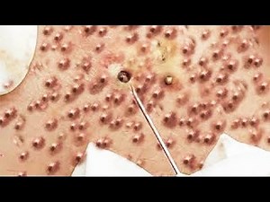 SAC DEP SPA acne treatment and removal blackheads (261) #SacDepSpa #blackheads #acnetreatment #acne