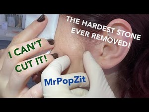 You have to see it to believe it! The hardest rock cyst (pilomatricoma)ever on film! In her face!