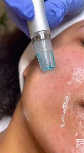 Extreme Pimple Popping & Dermatology Extractions | The Ultimate Satisfying Content(36) #short #acne