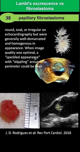 Lambl's Excrescences vs Papillary Fibroelastoma