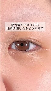 【目頭切開】 #shorts 蒙古襞レベル100どうなる？