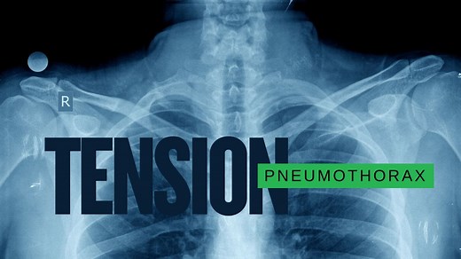 Tension pneumothorax: Needle decompression steps