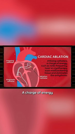 Supraventricular tachycardia, or SVT, is a fast heart rate – greater than 100 beats per minute. Many people with this arrythmia don’t need any treatment, but if you have frequent episodes of SVT, your doctor may recommend ablation. Here’s how it works. | American Heart Association