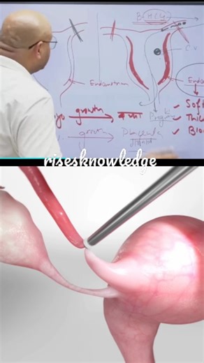 B. r.... on Instagram: "After a tubectomy🩸👨‍⚕️, women continue to have their periods normally because the procedure is a form of contraception that does not affect the hormonal cycle, ovulation, or the function of the ovaries and uterus. The Mechanism of Menstruation After Tubectomy The tubectomy (also known as tubal ligation or "getting your tubes tied") works as follows: Fallopian Tubes are Blocked/Cut: The surgery involves blocking, cutting, or sealing the fallopian tubes, which are the pat