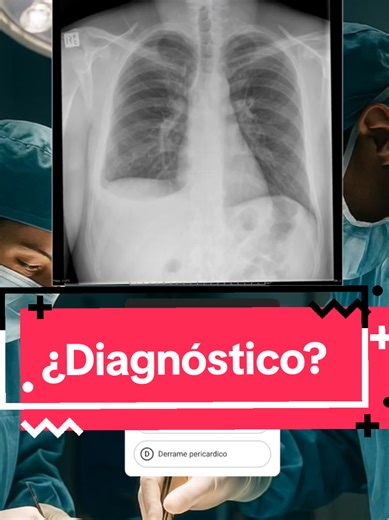 Derrame Pleural: Diagnóstico y Estudio de Caso