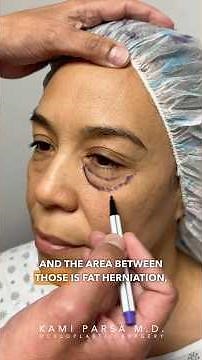 Puffy Eye Bag Anatomy Explained