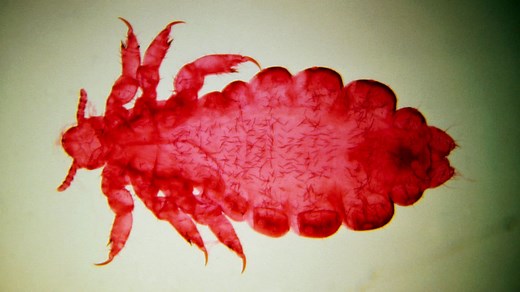 Disease spread by body lice found in 7 Alberta organ transplant recipients