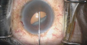 Removal of Cataract in Patient With Ectopia Lentis et Pupillae - Eyetube