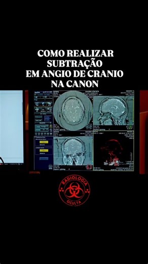 Jefferson Vallarini radiologia_oculta on Instagram: "​🧠 Subtração de Angio-TC de Crânio: Passo a Passo Canon ​Domine a técnica de subtração (DSA-like) para otimizar a visualização de aneurismas, MAVs e estenoses nos exames de Angio-TC de Crânio no seu tomógrafo Canon. ​💡 Por Que Subtrair? ​A subtração remove digitalmente a estrutura óssea do crânio, isolando apenas os vasos preenchidos por contraste. O resultado é uma imagem MIP de alta qualidade (Maximum Intensity Projection), livre de artefa