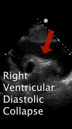 Signs of Pericardial Tamponade #POCUS #ultrasound #emergencymedicine#cardiology #criticalcare