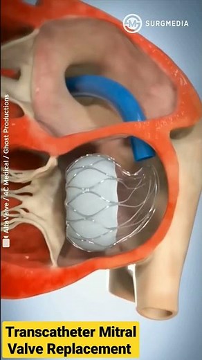 Altavalve: Transcatheter Mitral Valve Replacement (TMVR) #shorts #medical #animation