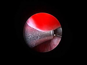 Urolift Surgery • Video • MEDtube.net