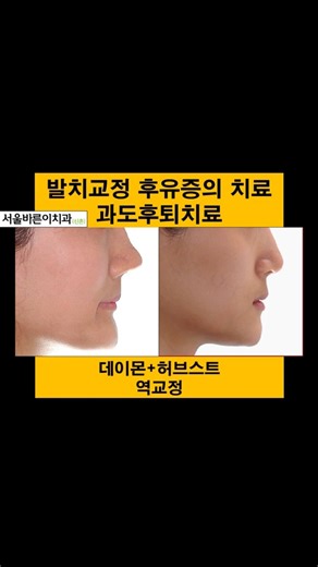 입이 후퇴된 증례, 발치 후유증, 과도후퇴의 치료