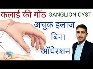 कलाई की गाँठ | Ganglion Cyst बिना ऑपरेशन इलाज | Homeopathic Treatment for Ganglion Cyst