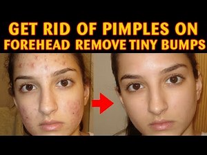 How to Get Rid of Pimples on Forehead Remove Tiny Bumps Fast With Home Remedies