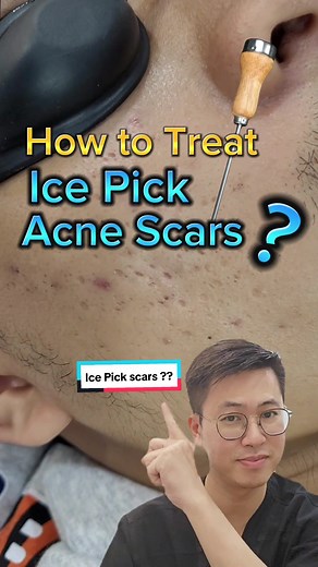 Ice pick acne scars are like small, V-shaped holes in the skin. TCA Cross (Trichloroacetic Acid Cross) is a dermatological procedure used to treat these scars. 🔄 It involves applying a high concentration of trichloroacetic acid to the scar base, stimulating collagen production, and improving the scar over time. 🌟 The benefits include promoting skin remodeling, reducing scar depth, and enhancing overall skin texture. 🎉 Multiple sessions may be needed for optimal results, and post-treatment car