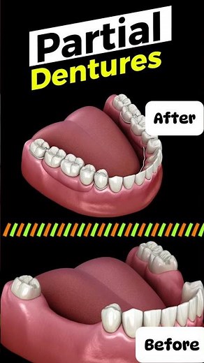 Partial Dentures: A Simple Fix for Missing Teeth