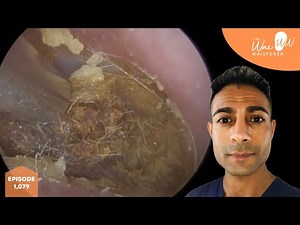 1,079 - Crusted Ear Wax Removal off Eardrum
